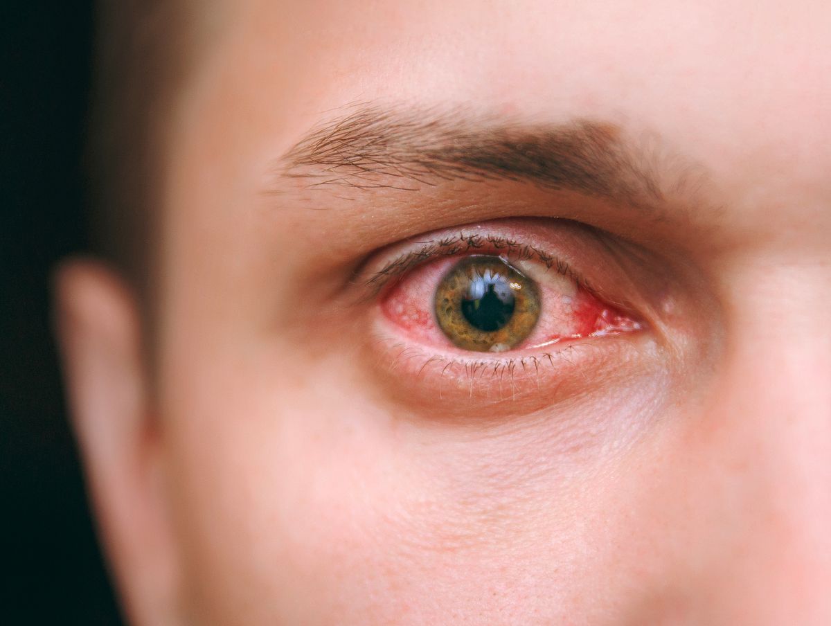 From allergy ‘red eye’ to respiratory crashing: Kirkland nurses describe coronavirus scourge 1 From allergy ‘red eye’ to respiratory crashing: Kirkland nurses describe coronavirus scourge 1