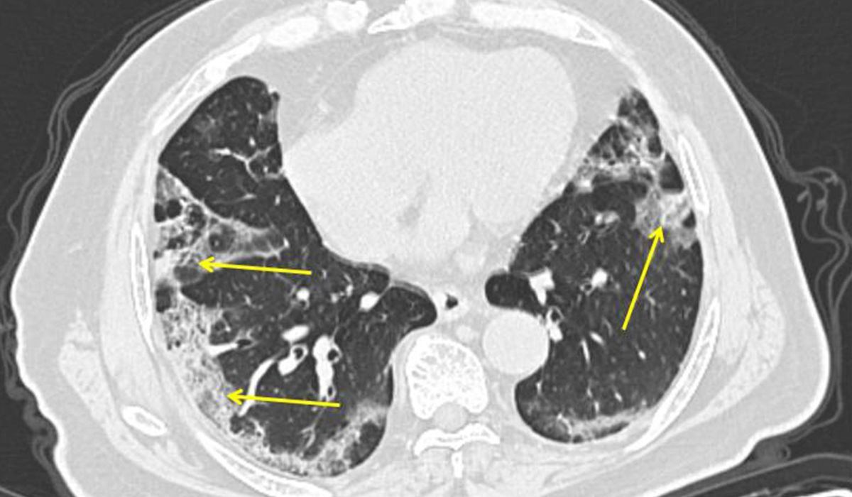 COVID-19 lung patterns show few clues for treating pneumonia 1