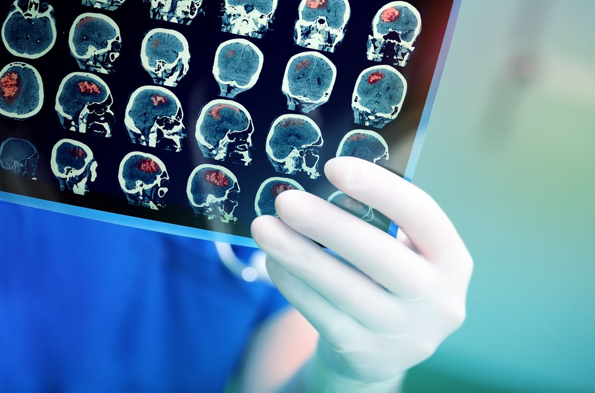 Coronavirus can increase stroke risk in young adults:
doctors 1 Coronavirus can increase stroke risk in young adults:
doctors 1