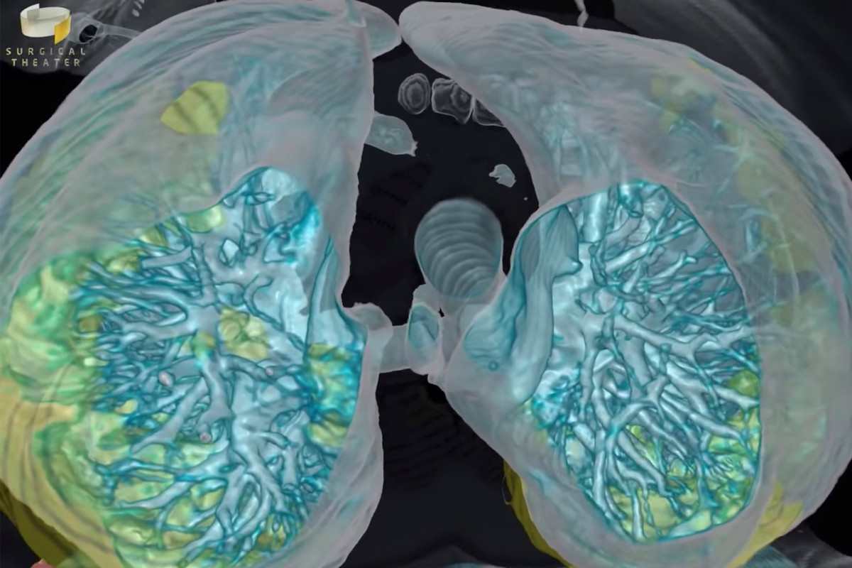 Coronavirus may damage your kidneys, heart and liver 1