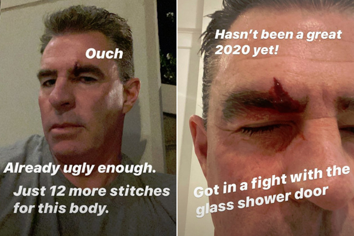Jim Edmonds gets stitches in forehead days after testing positive for coronavirus 1