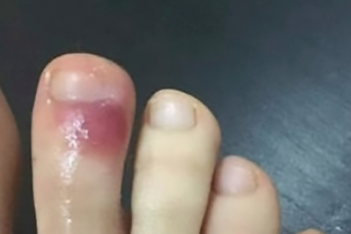 Foot sores could be an early sign of coronavirus, experts say 1 Foot sores could be an early sign of coronavirus, experts say 1