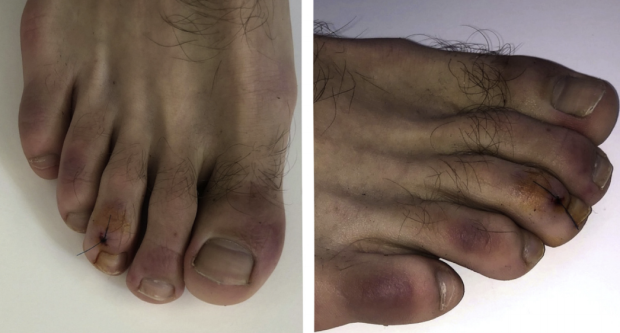 "COVID toes" may be coronavirus symptom 1