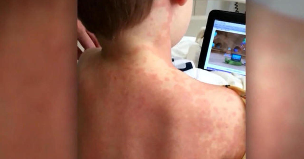 More children diagnosed with illness possibly linked to the
coronavirus 1