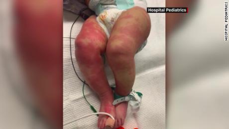 Doctors in Italy make a link between Covid-19 and rare
disease in children 1