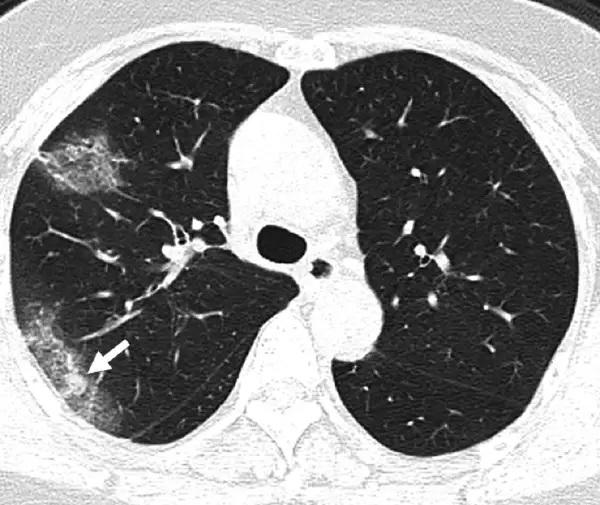 'Thousands' Of Dutch COVID-19 Survivors Likely Have
Permanent Lung Damage According To Top Pulmonologist 1