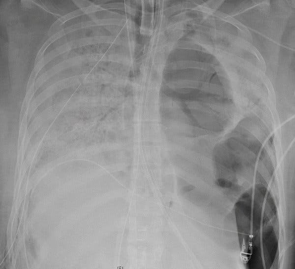 Covid-19 Patient Gets Double Lung Transplant, Offering Hope
for Others 1