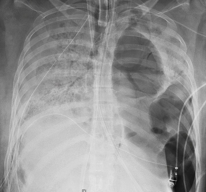 Woman Becomes First Known COVID-19 Patient In U.S. To
Receive Double Lung Transplant 1