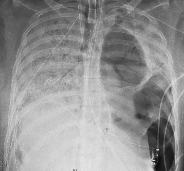 Young woman with COVID-19 gets double lung transplant in
Chicago 1