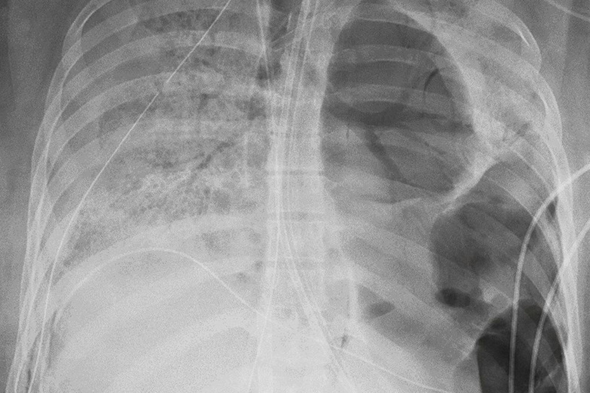 Woman in her twenties has double lung transplant due to
coronavirus 1