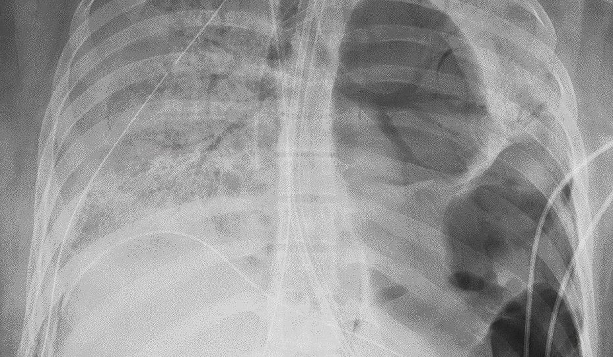 Coronavirus survivor in US receives double lung
transplant 1