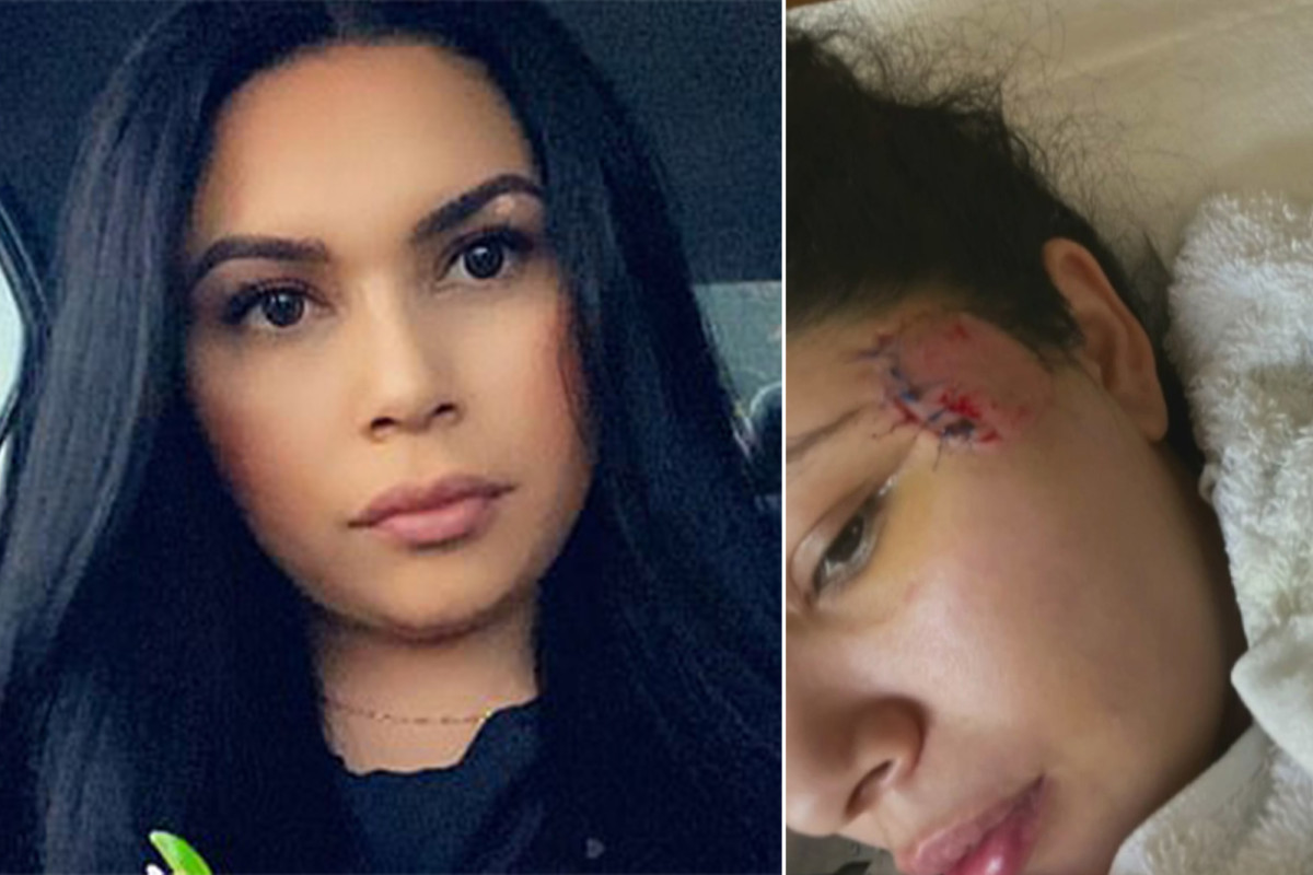 Mom struck by rubber bullet near LA protests says she
suffered brain injury 1