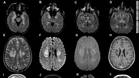 New warning: Coronavirus pandemic could cause wave of brain
damage 1