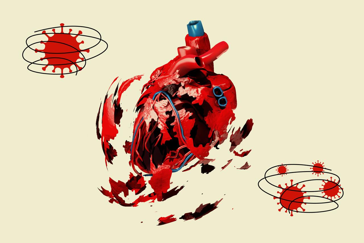 More Than Half Of COVID-19 Patients In New Study Have Heart
Damage 1 More Than Half Of COVID-19 Patients In New Study Have Heart
Damage 1