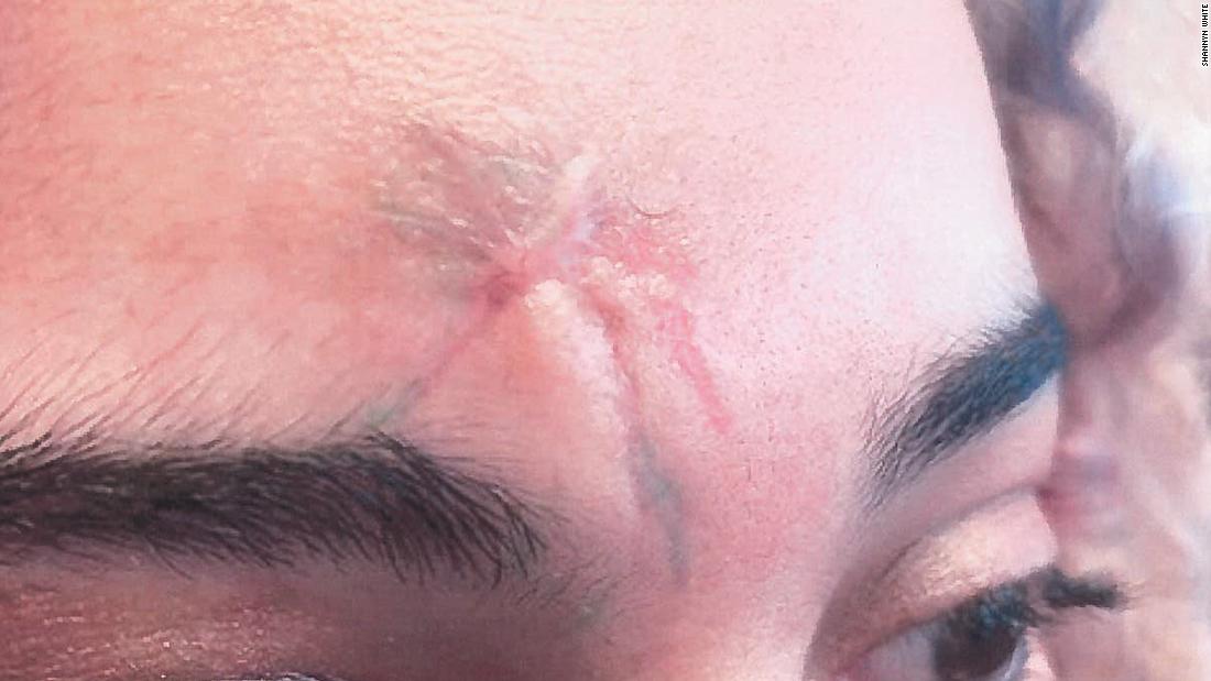 Woman sues after alleging she was shot with a rubber bullet
while peacefully protesting 1