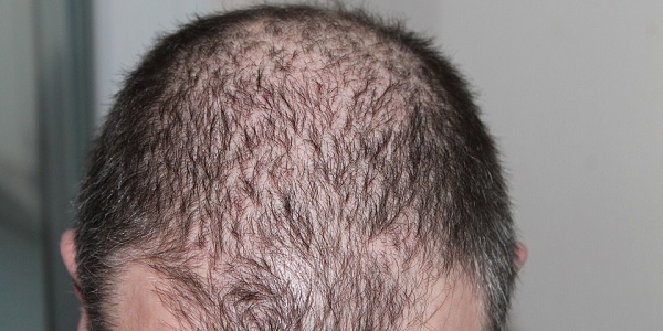 Patients report hair loss months after recovering from
COVID-19 1