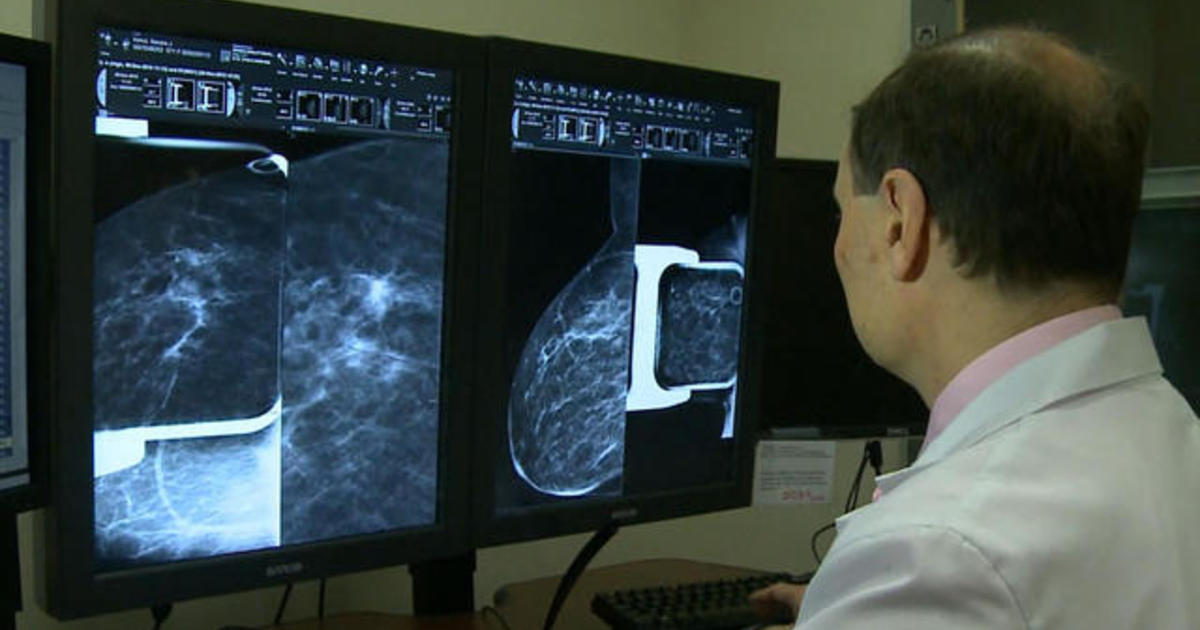 Breast cancer screenings plummet during coronavirus
pandemic 1