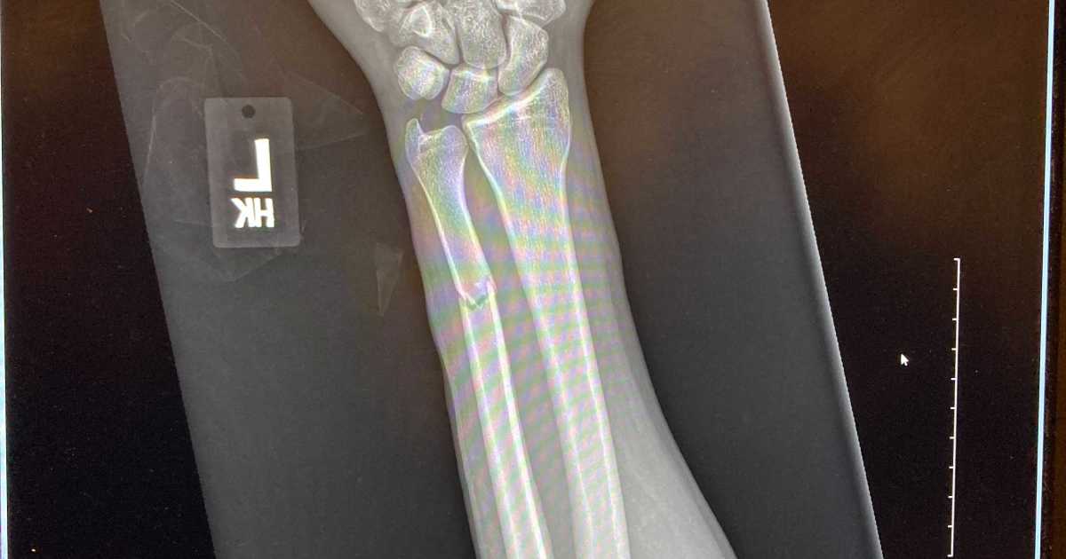 Echo Park protester alleges LAPD officer broke his arm with
baton strike 1