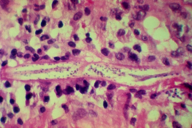 What Is Ivermectin Used for and Why Are People Taking the
Drug for COVID-19? 1