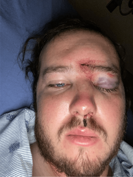 Protester’s skull fractured by Denver police during 2020
demonstrations, lawsuit against city alleges 1
