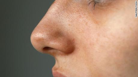 More than a million people in the US may not have regained
sense of smell months after Covid-19 infection, study
estimates 1