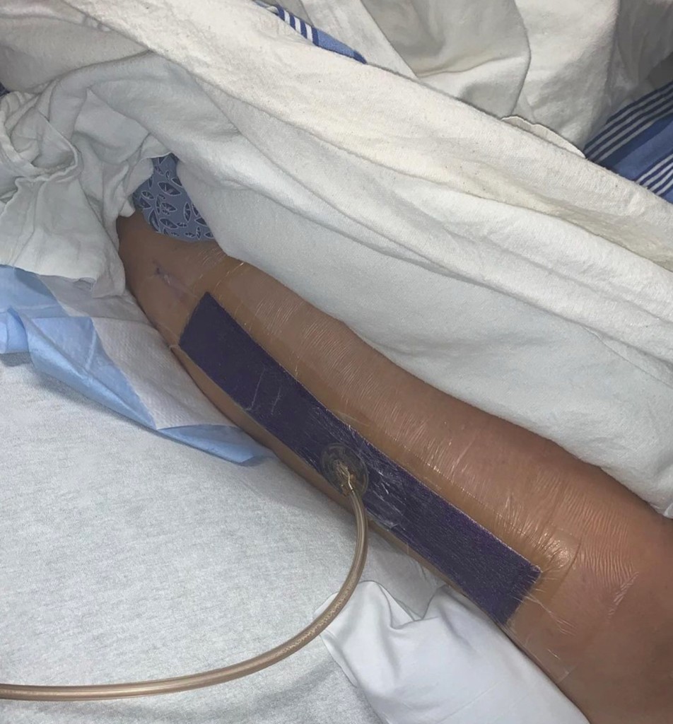 Woman reveals she nearly lost a leg after spin class 1